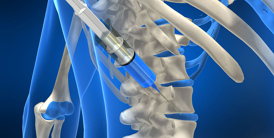 spinal disc stem cell therapy